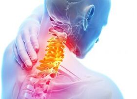 Schmerzen und Unterkünfte in der Gebärmutterhalszone mit dem dritten Grad der Osteochondrose