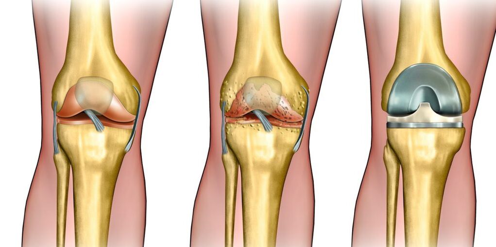 Arthrose des Kniegelenks