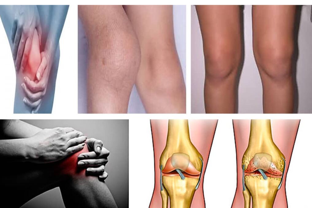Symptome der Arthrose des Knies